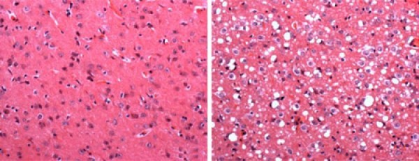 Células normais do cérebro de um rato (esquerda) e células afetadas por príons (direita). Observe a presença de pequenos “buracos” em branco. As células foram coradas e fotografadas em um microscópio de luz.
