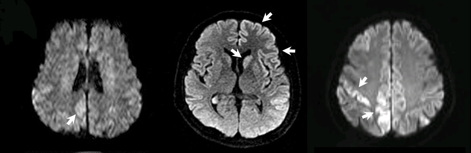 Imagens do cérebro de três pessoas com DJC. As setas indicam regiões de lesão no cérebro. Imagens obtidas por ressonância magnética. Fonte: https://upload.wikimedia.org/wikipedia/commons/0/06/CJD_profiles_of_MRI_and_EEG_from_probable_CJD_patient.jpg